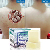 Pimple Removal Sea Salt Soap - Glefidiya